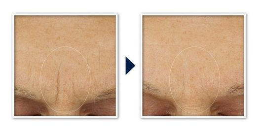 RoC Retinol Correxion Anti-Aging Retinol Moisturizer with Hydrating Hyaluronic Acid Fragrance Free 48 gr