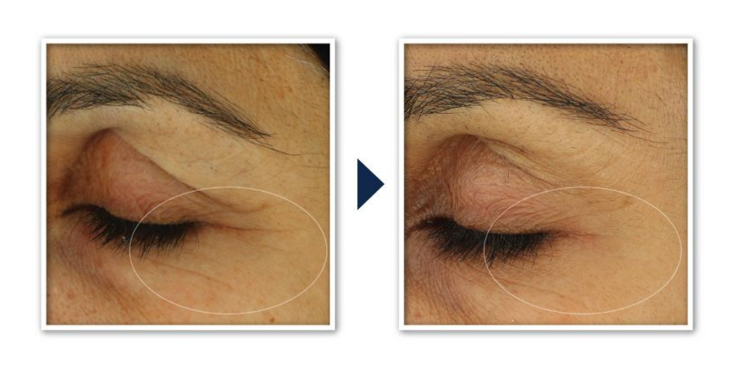 RoC Retinol Correxion Line Smoothing Anti-Aging Wrinkle Eye Cream for Dark Circles & Puffy Eyes 15 ml